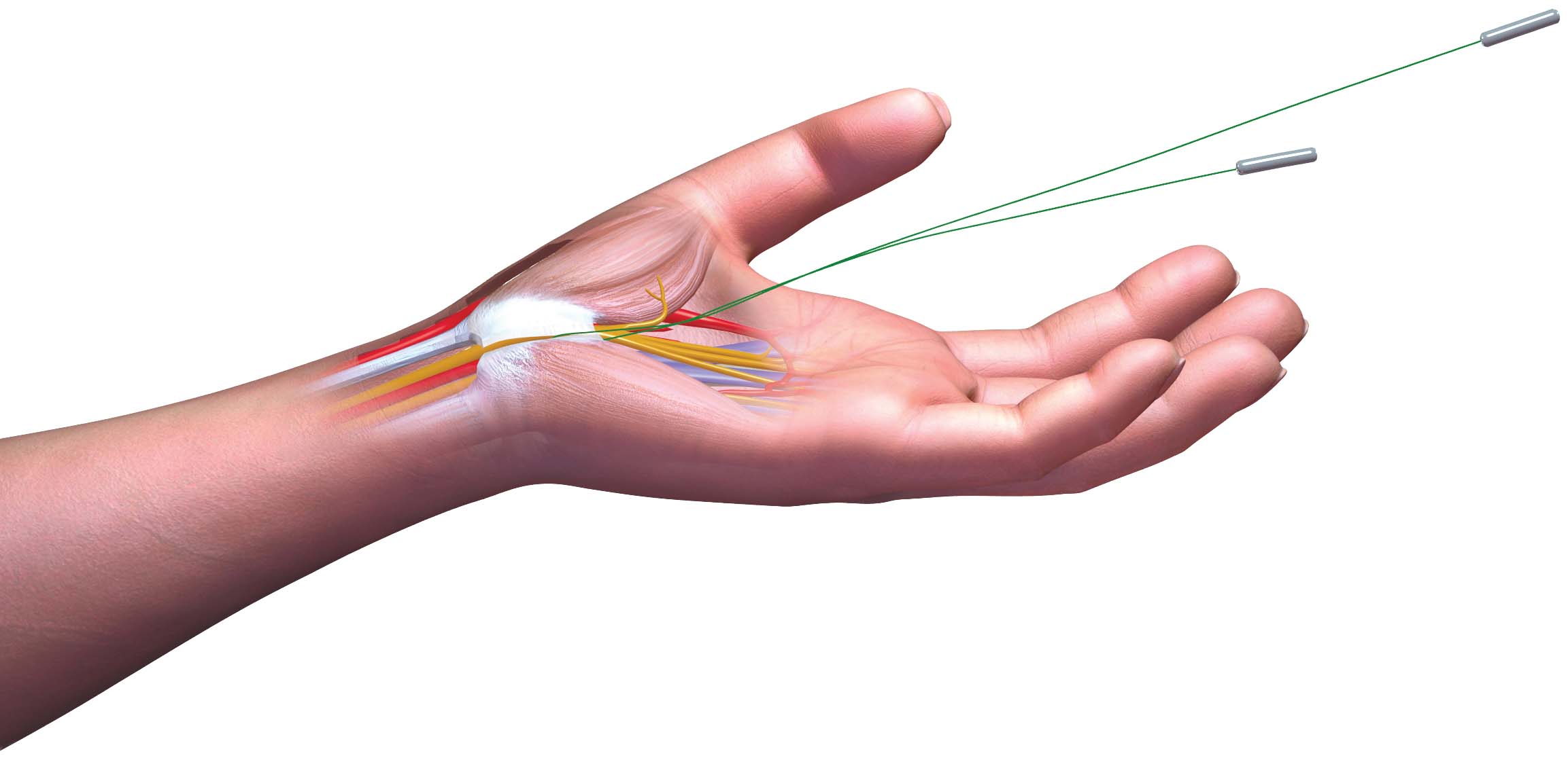 3_Cutting Ligament